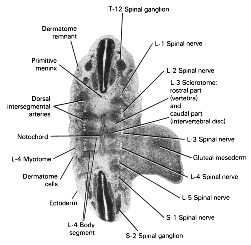 L-1 spinal nerve, L-2 spinal nerve, L-3 sclerotome: rostral part (vertebra) and caudal part (intervertebral disc), L-3 spinal nerve, L-4 body segment, L-4 myotome, L-4 spinal nerve, L-5 spinal nerve, S-1 spinal nerve, S-2 spinal ganglion, T-12 spinal ganglion, dermatome cells, dermatome remnant, dorsal intersegmental arteries, ectoderm, gluteal mesoderm, notochord, primitive meninx