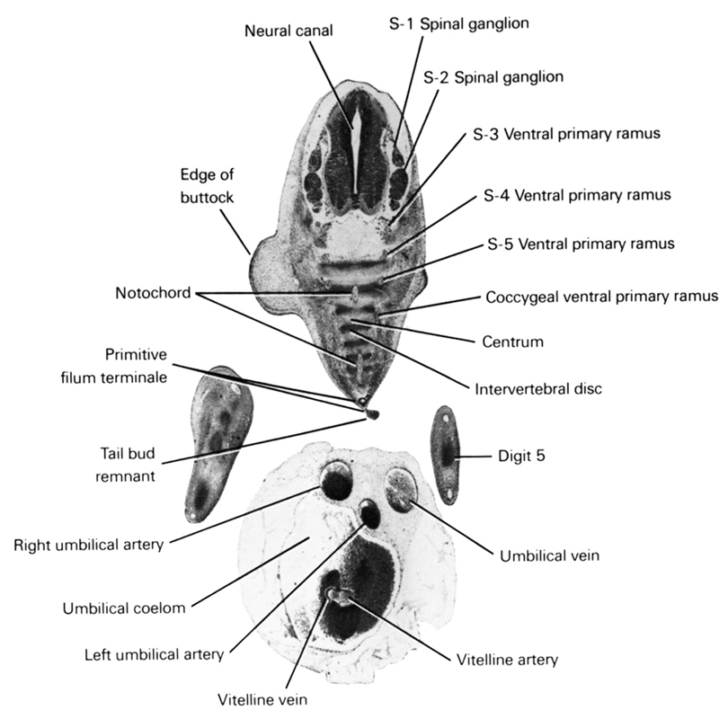 S-1 spinal ganglion, S-2 spinal ganglion, S-3 ventral primary ramus, S-4 ventral primary ramus, S-5 ventral primary ramus, centrum, coccygeal ventral primary ramus, digit 5, edge of buttock, intervertebral disc, left umbilical artery, neural canal, notochord, primitive filum terminale, right umbilical artery, tail bud remnant, umbilical coelom, umbilical vein, vitelline (omphalomesenteric) artery, vitelline (omphalomesenteric) vein