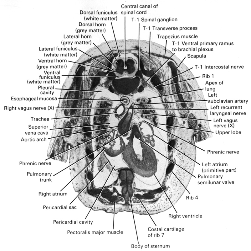 T-1 intercostal nerve, T-1 spinal ganglion, T-1 ventral primary ramus to brachial plexus, apex of lung, arch of aorta, body of sternum, central canal of spinal cord, dorsal funiculus (white matter), dorsal horn (grey matter), esophageal mucosa, lateral funiculus (white matter), lateral horn (grey matter), left atrium (primitive part), left recurrent laryngeal nerve, left subclavian artery, left vagus nerve (CN X), pectoralis major muscle, pericardial cavity, pericardial sac, phrenic nerve, pleural cavity, pulmonary semilunar valve, pulmonary trunk, rib 1, rib 4, rib 7 (costal cartilage), right atrium, right vagus nerve (CN X), right ventricle, scapula, superior vena cava, trachea, transverse process of T-1 vertebra, trapezius muscle, upper lobe of left lung, ventral funiculus (white matter), ventral horn (grey matter)