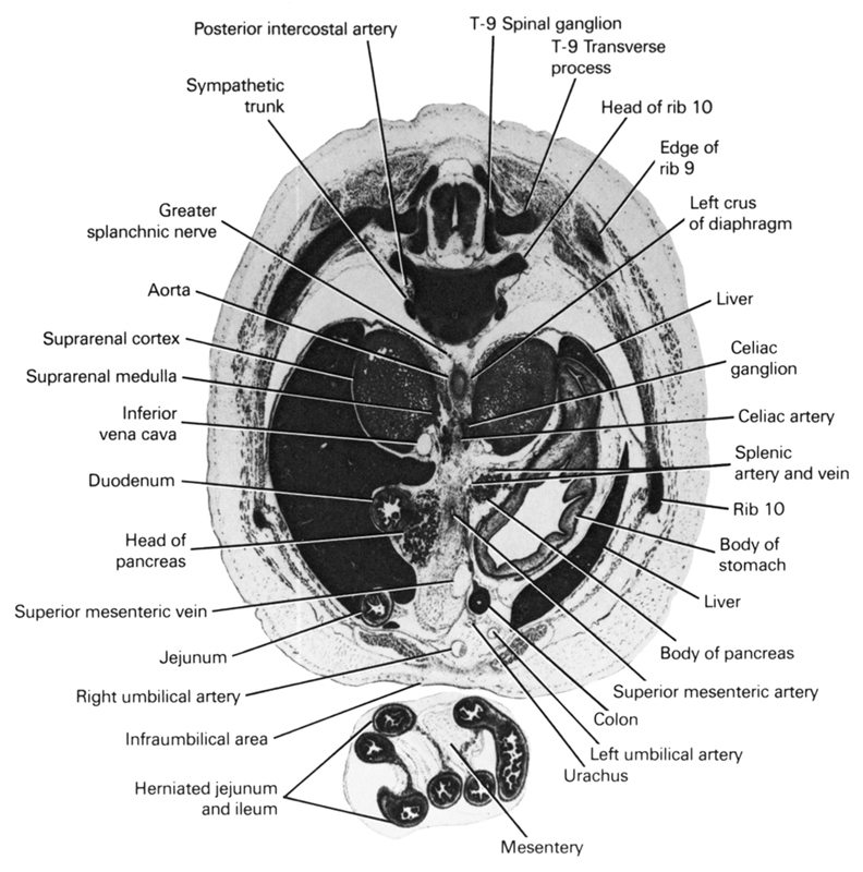 T- 9 transverse process, T-9 spinal ganglion, aorta, body of pancreas, body of stomach, celiac artery, celiac ganglion, colon, duodenum, edge of rib 9, greater splanchnic nerve, head of pancreas, head of rib 10, herniated jejunum and ileum, inferior vena cava, infra-umbilical area, jejunum, left crus of diaphragm, left umbilical artery, liver, mesentery, posterior intercostal artery, rib 10, right umbilical artery, splenic artery and vein, superior mesenteric artery, superior mesenteric vein, suprarenal cortex, suprarenal medulla, sympathetic trunk, urachus