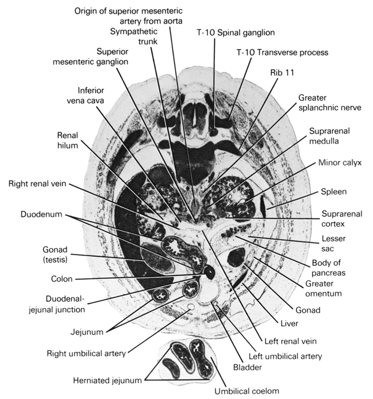 T-10 spinal ganglion, T-10 transverse process, body of pancreas, colon, duodenal jejunal junction, duodenum, gonad, gonad (testis), greater omentum, greater splanchnic nerve, herniated jejunum, inferior vena cava, jejunum, left renal vein, left umbilical artery, lesser  sac, liver, minor calyx, origin of superior mesenteric artery from aorta, renal hilum, rib 11, right renal vein, right umbilical artery, spleen, superior mesenteric ganglion, suprarenal cortex, suprarenal medulla, sympathetic trunk, umbilical coelom, urinary bladder