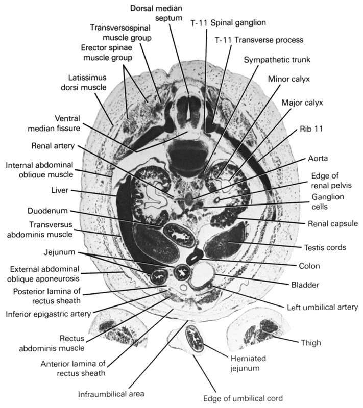 T-11 spinal ganglion, T-11 transverse process, anterior lamina of rectus sheath, aorta, colon, dorsal median septum, duodenum, edge of renal pelvis, edge of umbilical cord, erector spinae muscle group, external abdominal oblique aponeurosis, ganglion cells, herniated jejunum, inferior epigastric artery, infra-umbilical area, internal abdominal oblique muscle, jejunum, latissimus dorsi muscle, left umbilical artery, liver, major calyx, minor calyx, posterior lamina of rectus sheath, rectus abdominis muscle, renal artery, renal capsule, rib 11, sympathetic trunk, testis, thigh, transversopinal muscle group, transversus abdominis muscle, urinary bladder, ventral median fissure