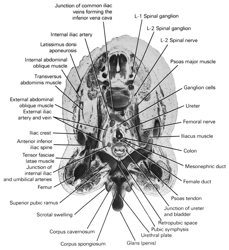 L-1 spinal ganglion, L-2 spinal ganglion, L-2 spinal nerve, anterior inferior iliac spine, colon, corpus cavernosum, corpus spongiosum, external abdominal oblique muscle, external iliac artery and vein, female duct, femoral nerve, femur, ganglion cells, glans (penis), iliac crest, iliacus muscle, internal abdominal oblique muscle, internal iliac artery, junction of common iliac veins forming the inferior vena cava, junction of internal iliac and umbilical arteries, junction of ureter and urinary bladder, latissimus dorsi aponeurosis, mesonephric duct, psoas major muscle, psoas tendon, pubic symphysis, retropubic space, scrotal swelling, superior pubic ramus, tensor fasciae latae muscle, transversus abdominis muscle, ureter, urethral plate