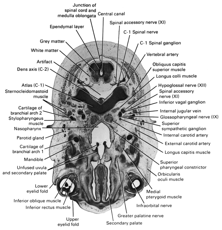 C-1 spinal ganglion, C-1 spinal nerve, C-1 vertebra (atlas), artifact(s), cartilage of pharyngeal arch 2, central canal, dens of C-2 vertebra (axis), ependymal layer, external carotid artery, glossopharyngeal nerve (CN IX), greater palatine nerve, grey matter, hypoglossal nerve (CN XII), inferior ganglion of vagus nerve (CN X), inferior oblique muscle, inferior rectus muscle, infra-orbital nerve, internal carotid artery, internal jugular vein, junction of spinal cord and medulla oblongata, longus capitis muscle, longus colli muscle, lower eyelid fold, mandible, medial pterygoid muscle, nasopharynx, obliquus capitis superior muscle, orbicularis oculi muscle, parotid gland, pharyngeal arch 1 cartilage (Meckel), secondary palate, spinal accessory nerve (CN XI), sternocleidomastoid muscle, stylopharyngeus muscle, superior pharyngeal constrictor muscle, superior sympathetic ganglion, unfused uvula and secondary palate, upper eyelid fold, vertebral artery, white matter