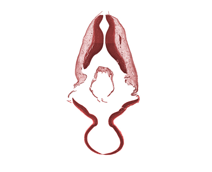 accessory nerve (CN XI), disrupted tissue (artifact), missing tissue (artifact), tissue fracture (artifact)