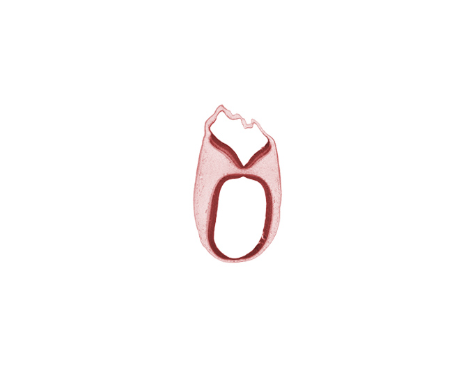 artifact fracture(s), intermediate zone, marginal zone, median sulcus, ventricular zone