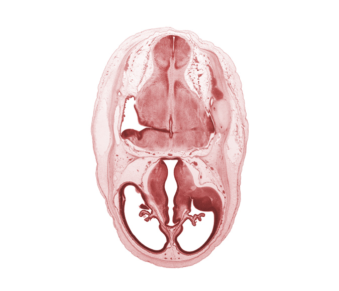 artifact separation(s), basilar artery, central canal, choroid plexus, dorsal thalamus, endolymphatic sac, falx cerebri region, hypothalamic sulcus, hypothalamus, lateral ventricle, marginal ridge, median sulcus, myelencephalon (medulla oblongata), osteogenic layer, posterior communicating artery, root of glossopharyngeal nerve (CN IX), stem of posterior dural venous plexus, sulcus dorsalis, sulcus medius, surface ectoderm, venous plexus(es), ventral thalamus