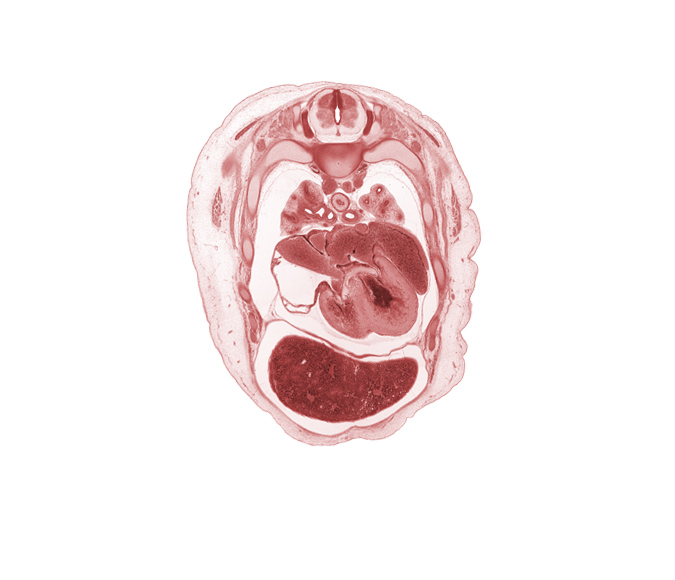 T-3 spinal ganglion, apical segmental bronchus, atrioventricular sulcus, azygos vein, edge of scapula, interventricular sulcus, left atrium, left lobe of liver, left vagus nerve (CN X), left ventricle, muscular part of interventricular septum, phrenic nerve, pleural cavity, primary bronchus, rib 4, rib 5, right atrioventricular (tricuspid) valve, right atrium, right lobe of liver, serratus anterior muscle, sinus venosus, superior hemi-azygos vein, upper lobe of left lung, upper lobe of right lung, upper secondary bronchus