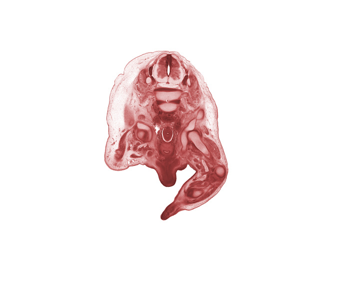 L-3 dorsal root, L-3 spinal ganglion, L-4 / L-5 intervertebral disc, L-4 spinal ganglion, L-4 spinal nerve, corpus cavernosum, hip joint, junction of rectum and sigmoid colon, lateral epicondyle of femur, neural arch, peritoneal cavity, sciatic nerve, scrotal swelling, shaft of penis, tibia, tibial nerve, urethra