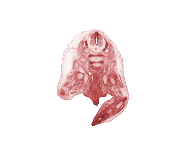 L-4 / L-5 intervertebral disc, L-4 spinal ganglion, L-4 spinal nerve, L-5 / S-1 intervertebral disc, L-5 spinal ganglion, L-5 spinal nerve, centrum of L-5 vertebra, centrum of S-1 vertebra (cephalic edge of sacrum), common fibular nerve, femur, fibula, glans penis, ilium, ischium, rectum, scrotal swelling, tibial nerve, urethra