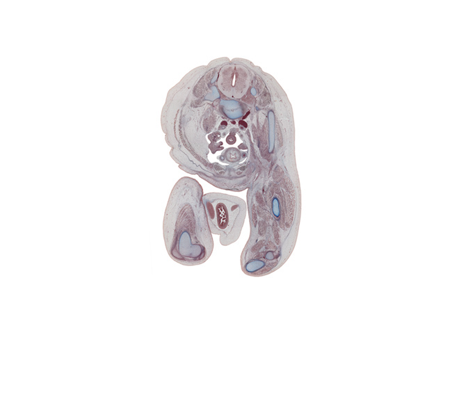 L-4 spinal ganglion, L-4 spinal nerve, adductor longus muscle, adductor magnus muscle, biceps femoris muscle, common fibular nerve, external abdominal oblique muscle, external iliac artery, femoral artery, femoral nerve, femur, gracilis muscle, gubernaculum of testis, head of fibula, herniated intestines, iliacus muscle, inferior epigastric artery, internal abdominal oblique muscle, lateral head of gastrocnemius muscle, left common iliac artery, left common iliac vein, medial head of gastrocnemius muscle, mesosigmoid, opening of paramesonephric duct, popliteus muscle, psoas major muscle, pyramidalis muscle, rectus abdominis muscle, right common iliac artery, sciatic nerve, semimembranosus muscle, semitendinosus tendon, sigmoid colon, tibia, tibial nerve, transversus abdominis muscle, umbilical coelom, umbilical cord, ureter, vas deferens