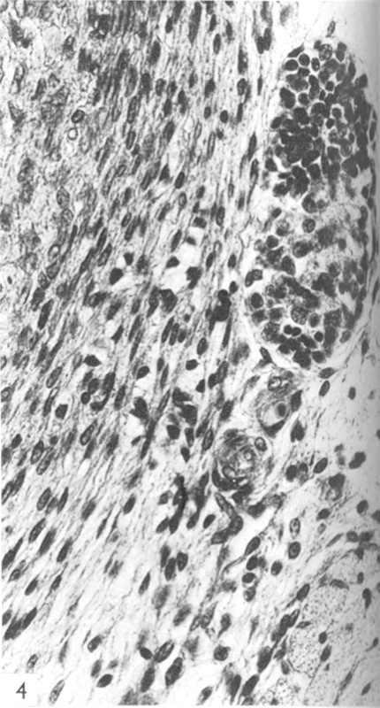 Ganglion at a higher magnification