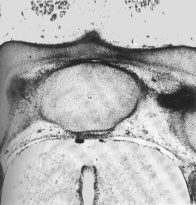 Median atlanto-axial joint