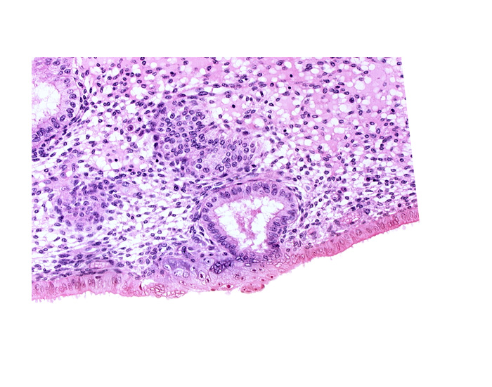 disrupted endometrial epithelium, edematous endometrial stroma (decidua), endometrial epithelium, lumen of endometrial gland, syncytiotrophoblast