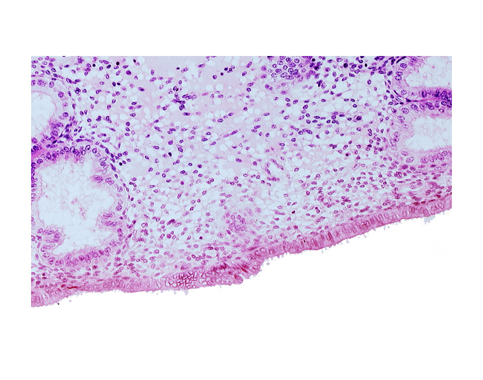 disrupted endometrial epithelium, edematous endometrial stroma (decidua), endometrial epithelium, lumen of endometrial gland