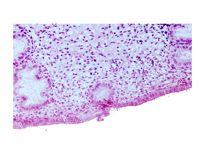 disrupted endometrial epithelium, edematous endometrial stroma (decidua), endometrial epithelium, endometrial gland