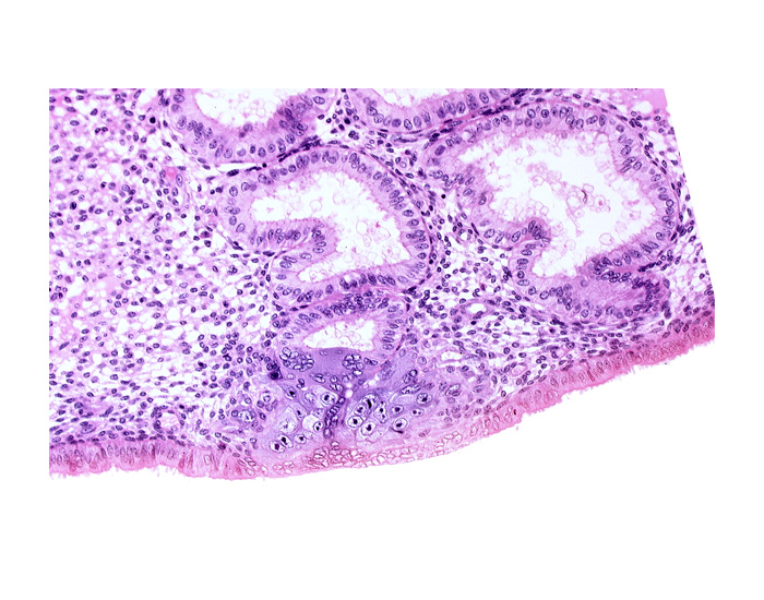 cytotrophoblast, edematous endometrial stroma (decidua), endometrial epithelium, endometrial gland, intact endometrial epithelium, solid syncytiotrophoblast