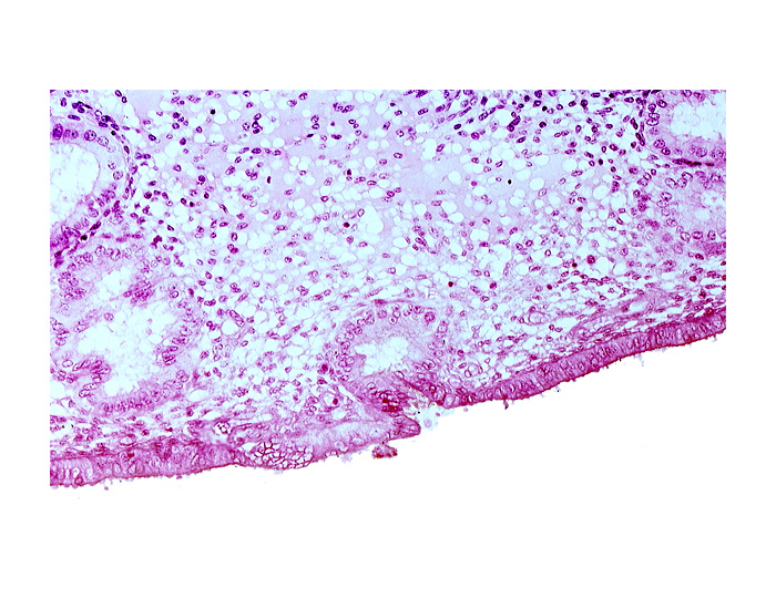 disrupted endometrial epithelium, edematous endometrial stroma (decidua), endometrial epithelium, lumen of endometrial gland