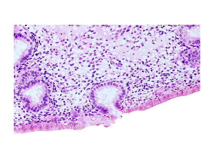 disrupted endometrial epithelium, edge of solid syncytiotrophoblast, endometrial epithelium, lumen of endometrial gland, mouth of endometrial gland