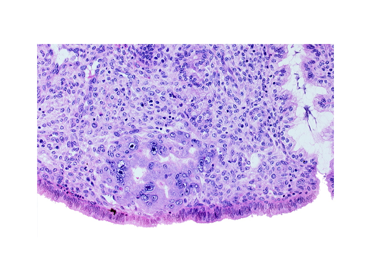 endometrial sinusoid, intact endometrial epithelium, uterine cavity