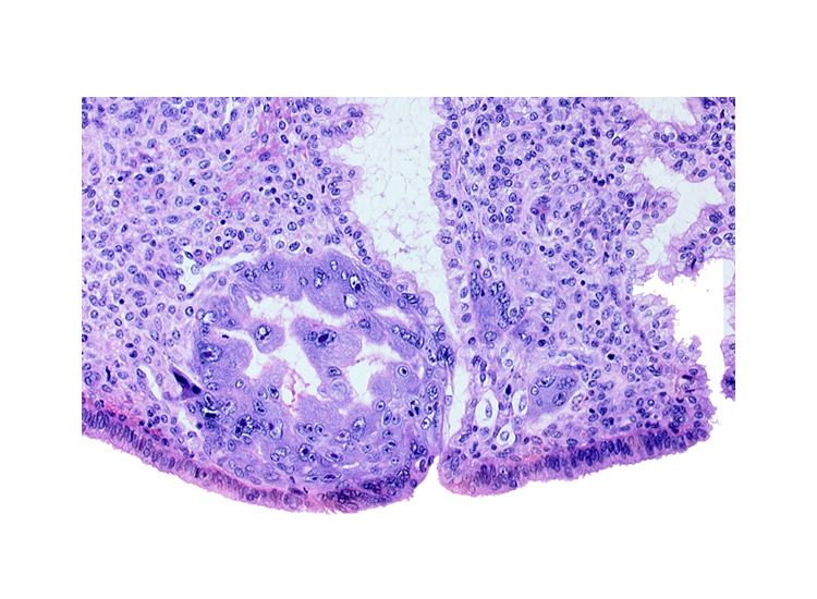 endometrial epithelium, syncytiotrophoblast, uterine cavity