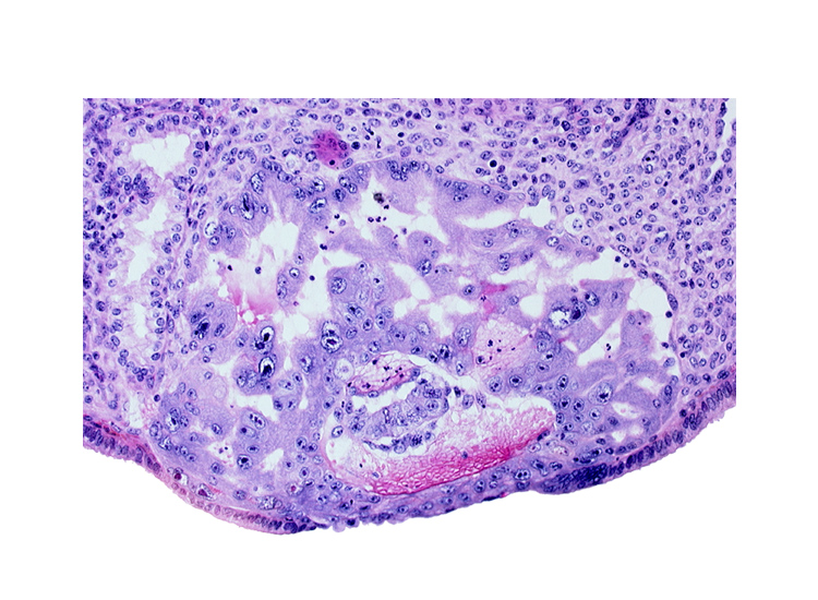 amnioblast(s), amniotic cavity, disrupted endometrial epithelium, endometrial sinusoid, epiblast, extra-embryonic endoblast, hypoblast, uterine cavity