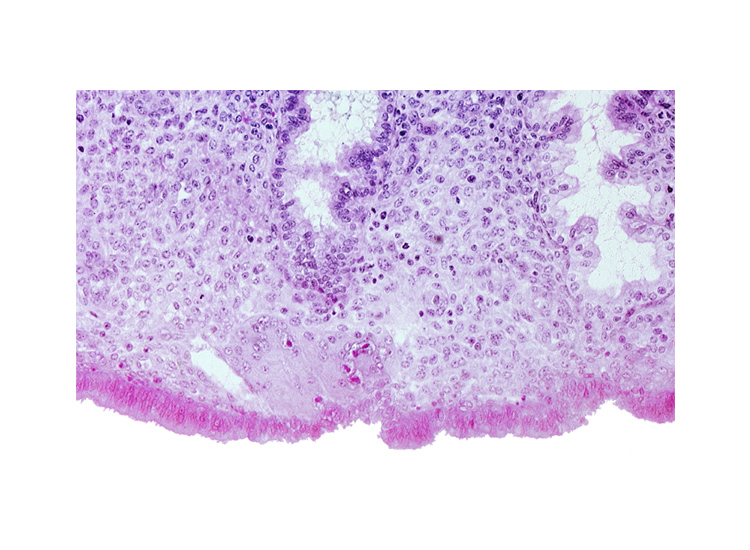 edematous endometrial stroma (decidua), endometrial sinusoid, intact endometrial epithelium, lumen of endometrial gland, uterine cavity