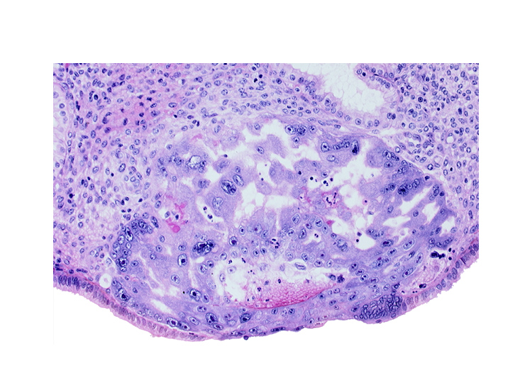 cytotrophoblast, edge of embryonic disc, extra-embryonic endoblast, maternal blood cells in primary umbilical vesicle cavity, primary umbilical vesicle cavity