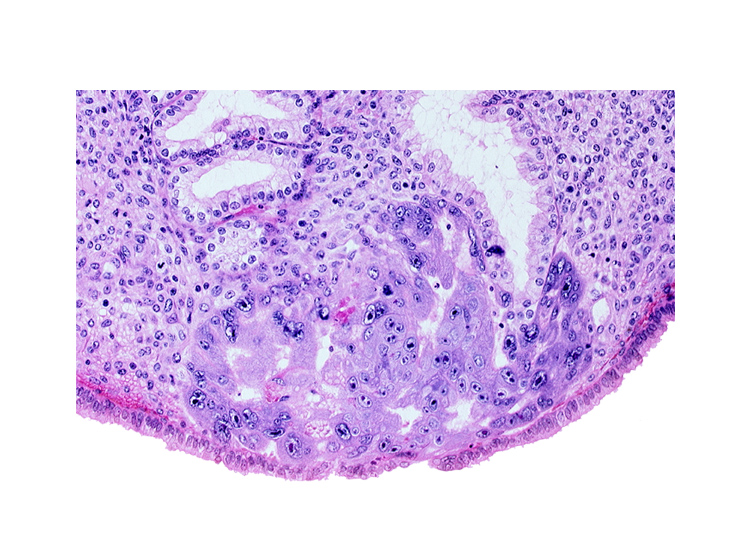 disrupted endometrial epithelium, endometrial epithelium, endometrial gland, intercommunicating lacunae, syncytiotrophoblast