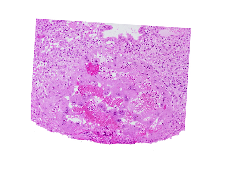 endometrial epithelium, endometrial stroma (decidua), intercommunicating lacunae, lacunar vascular circle, maternal blood cells in trophoblast lacuna, syncytiotrophoblast, uterine cavity