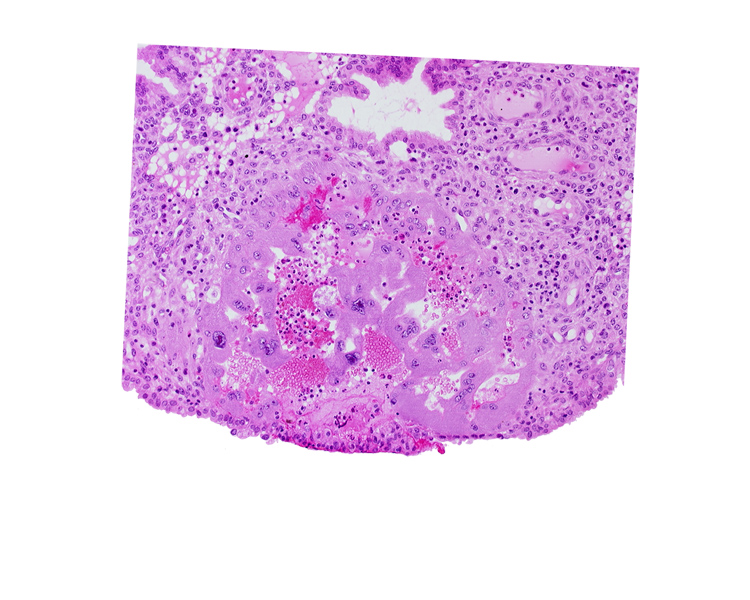 endometrial epithelium, endometrial sinusoid, endometrial stroma (decidua), intercommunicating sinusoid, lacunar vascular circle, lumen of endometrial gland, syncytiotrophoblast, uterine cavity