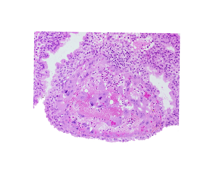 maternal blood cells in trophoblast lacuna, mouth of endometrial gland, syncytiotrophoblast