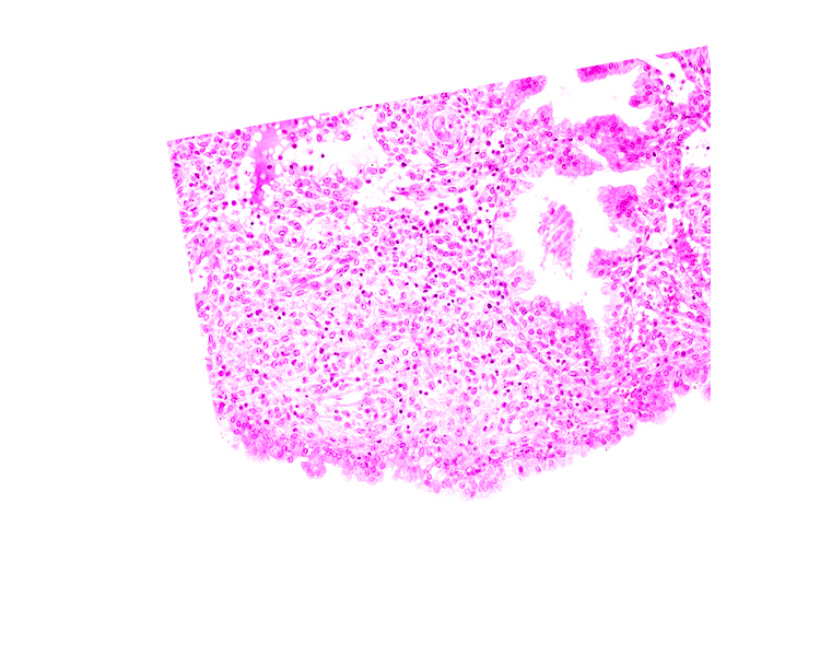 endometrial stroma (decidua), uterine cavity