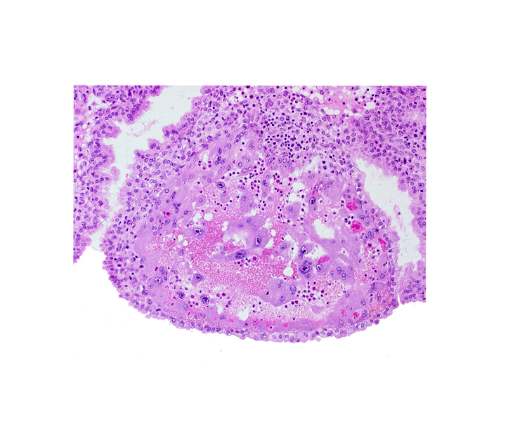 endometrial epithelium, lumen of endometrial gland, maternal blood cells in trophoblast lacuna, mouth of endometrial gland