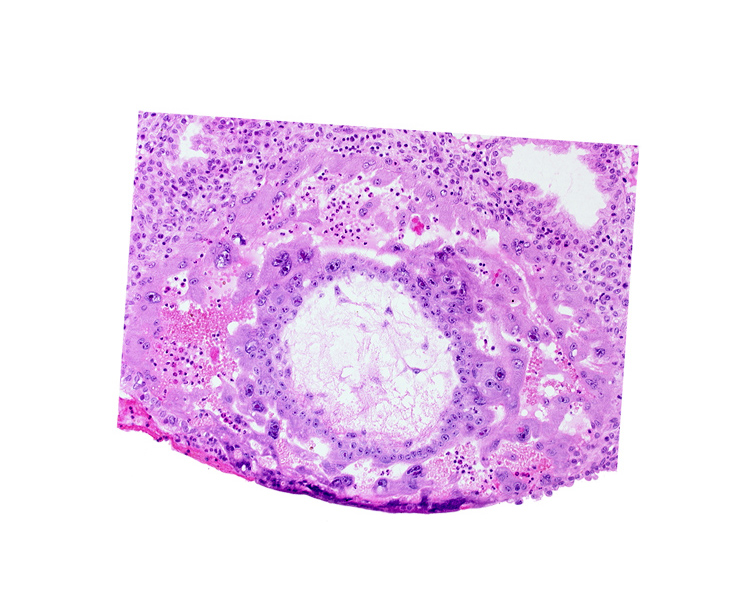 chorion, chorionic cavity, disrupted endometrial epithelium, extra-embryonic reticulum