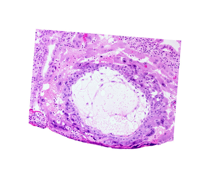 chorionic cavity, disrupted endometrial epithelium, uterine cavity