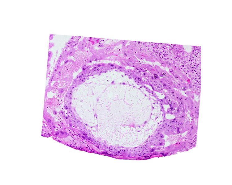 chorionic cavity, extra-embryonic mesoblast, uterine cavity