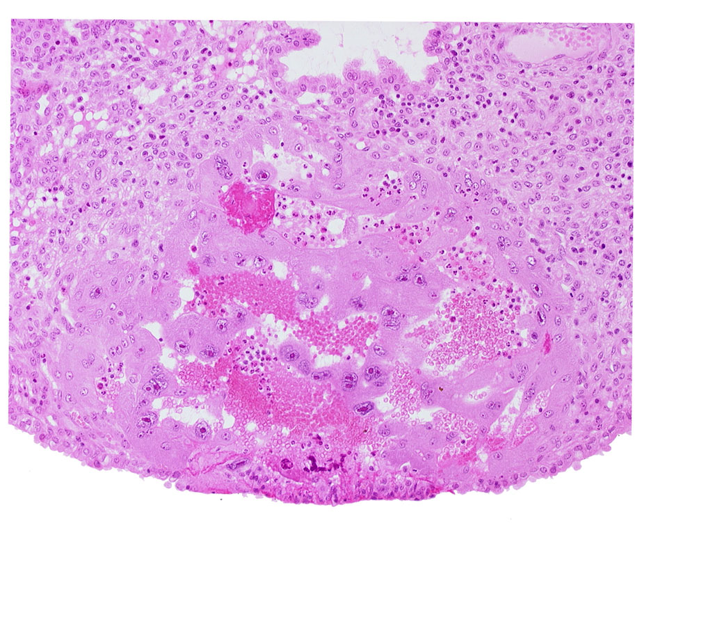 endometrial epithelium, endometrial stroma (decidua), intercommunicating lacunae, lacunar vascular circle, maternal blood cells in trophoblast lacuna, syncytiotrophoblast, uterine cavity