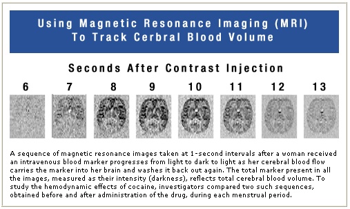 Using magnetic resonance imaging (MRI) to track cerebral blood volume