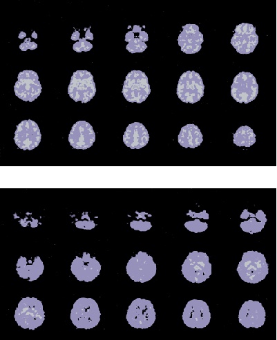 brain scans