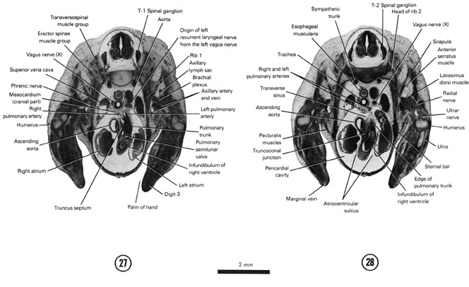 Mitral Valve Stenosis