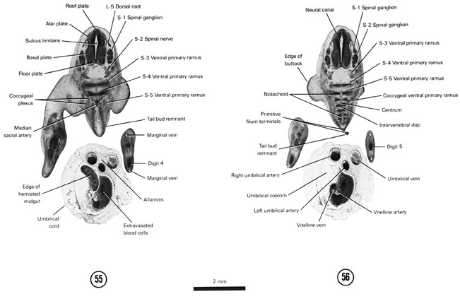 Open PDF version of FIG 7-33, A section through the caudal edge of the herniated midgut. A section through the S-2 spinal ganglion and the ventral primary rami of remaining spinal nerves (S-3 through coccygeal).