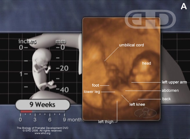 The 9 Week Fetus as Seen via 4 Dimensional Ultrasound  The 9 Week