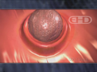 Early Implantation