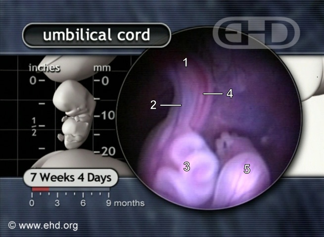 Base del cordón umbilical a las 7½ semanas [Haga clic para la siguiente imagen]