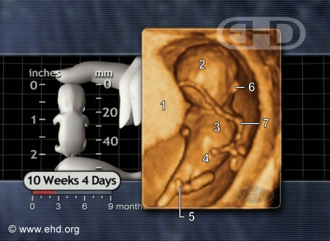 Hérnia Intestinal Resolvida [Clique para a próxima imagem]