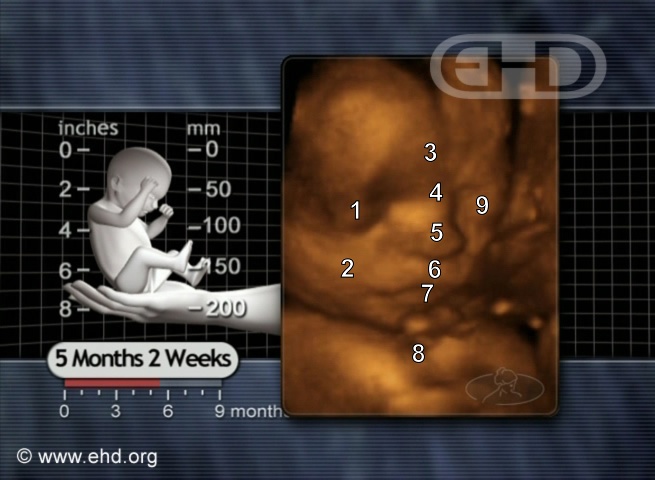 Rostro de feto de 22 semanas [Haga clic para la siguiente imagen]