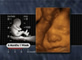 Rostro de feto de 25 semanas