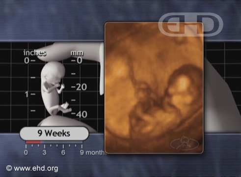 El feto de 9 semanas en movimiento [Haga clic para la siguiente imagen]