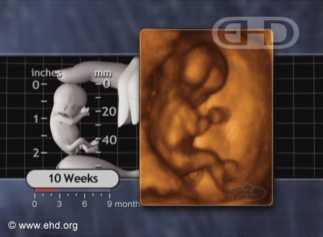 El feto de 10 semanas [Haga clic para la siguiente imagen]